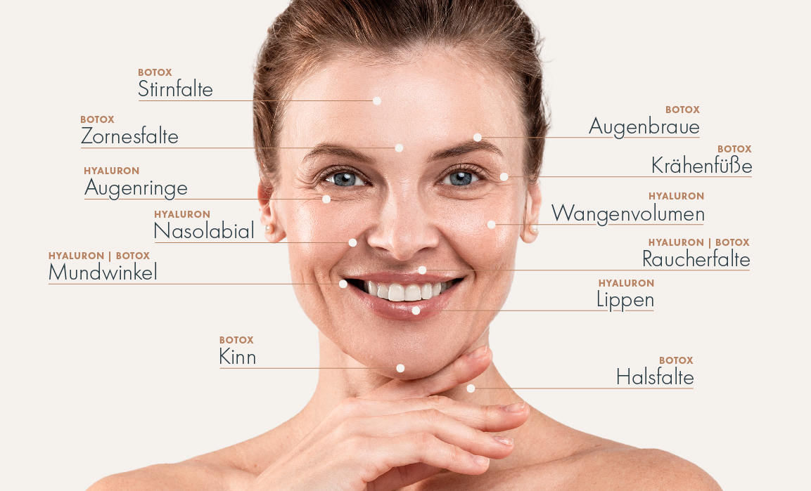 Behandlungszonen für Botox® und Hyaluron im Gesicht einer Frau